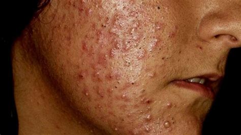 comedón gigante en la piel facial