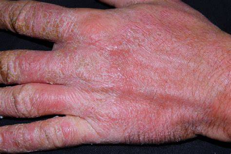 Dermatitis en manos por uso prolongado de guantes