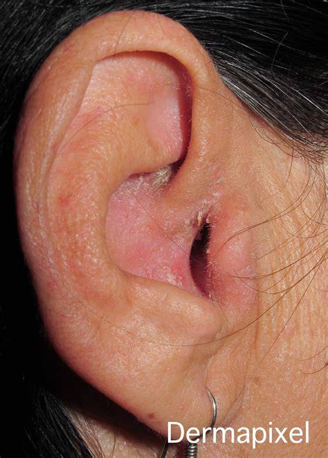 Dermatitis seborreica en oreja