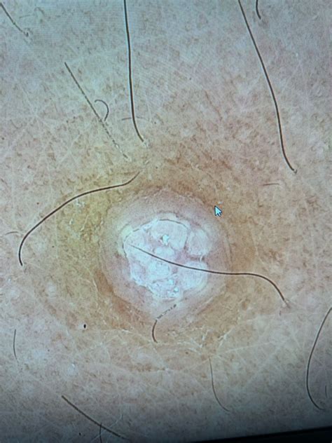 Dermatoscopia digital de molusco contagioso