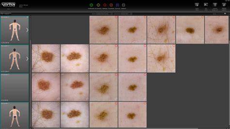 Dermatoscopia digital para revisar lunares