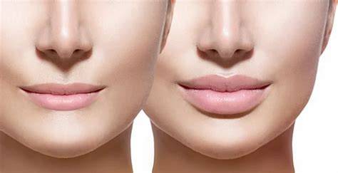 Antes y después de relleno labial natural