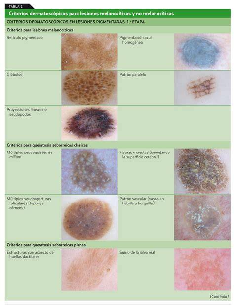 Dermatoscopia de lunares con dermatoscopio
