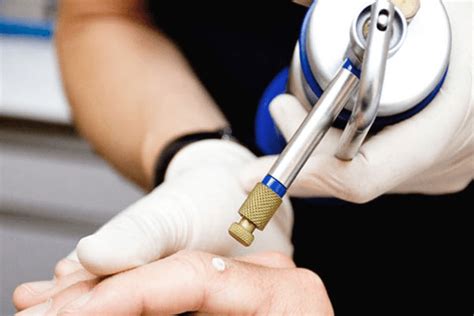 Crioterapia dermatológica con nitrógeno líquido