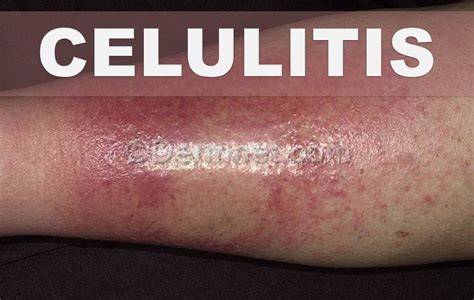 Celulitis infecciosa en pierna con manchas rojas