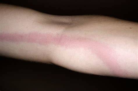 Celulitis y líneas rojas por linfangitis