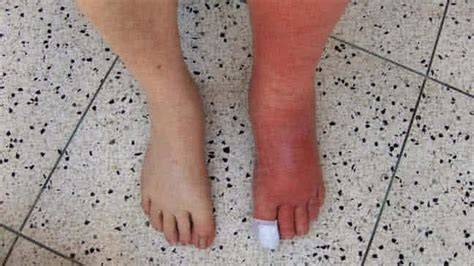 Celulitis infecciosa en pie y dedos