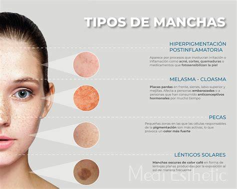 Tipos de manchas faciales y causas