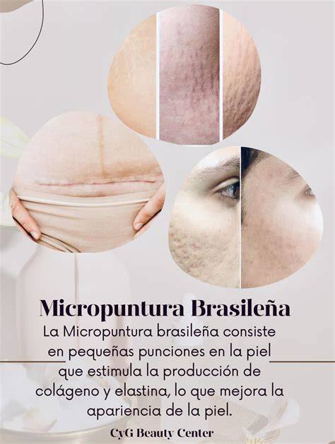 micropuntura brasileña estrías