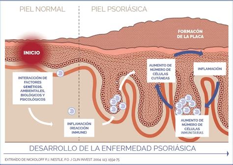 Inflamación inmunitaria de la psoriasis