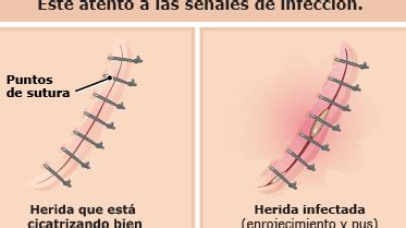 Signos de infección en herida con puntos