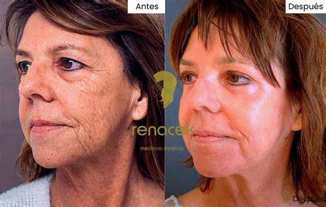 Peeling químico facial antes y después