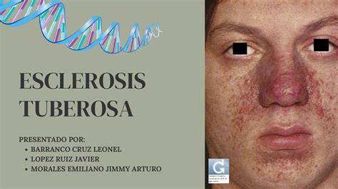 manifestaciones cutáneas de esclerosis tuberosa