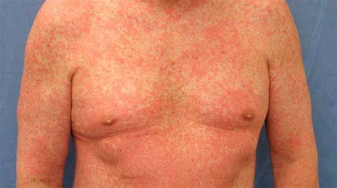 Erupción cutánea por inhibidores EGFR
