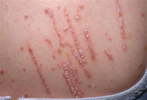 Fenómeno de Koebner en psoriasis crónica