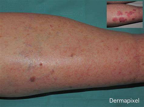 Tratamiento tópico de placas psoriásicas