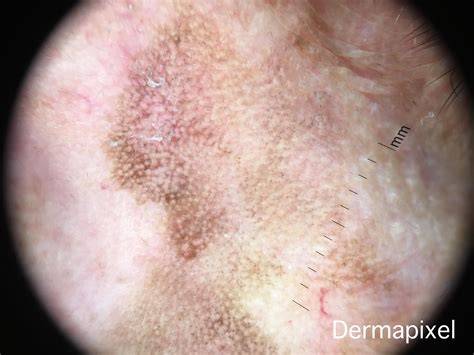 Dermatoscopia de léntigo solar facial