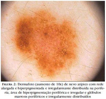 Dermatoscopia de nevus atípico