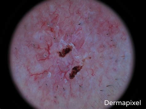 Dermatoscopia de carcinoma basocelular pigmentado