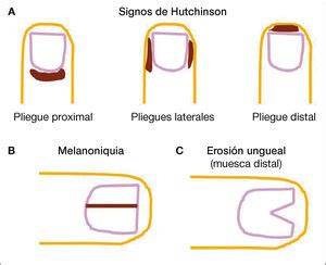 Melanoniquia longitudinal y signo de Hutchinson