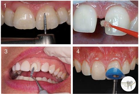 Proceso de colocación de carillas dentales