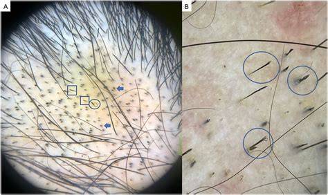 Dermatoscopia del cuero cabelludo femenino