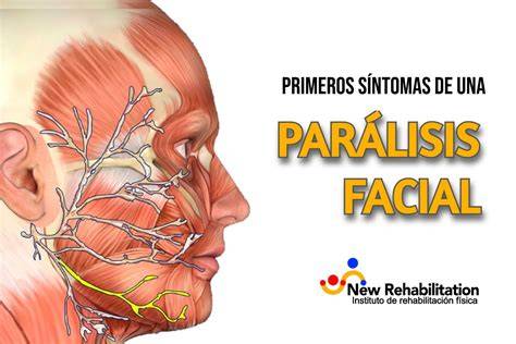 nervio facial y parálisis facial
