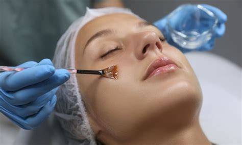 aplicación de peeling facial con ácidos frutales