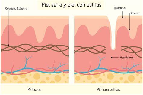 Estrías del crecimiento en la piel adolescente
