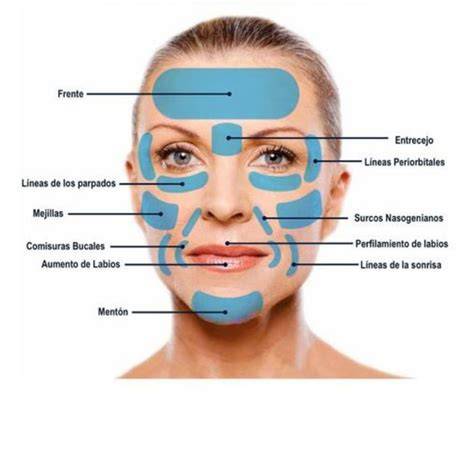 Relleno facial con ácido hialurónico
