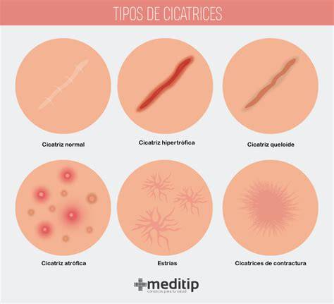 Tipos de cicatrices y estrías