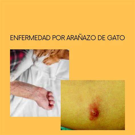 arañazo de gato con impétigo