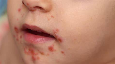 impétigo costroso en rostro infantil