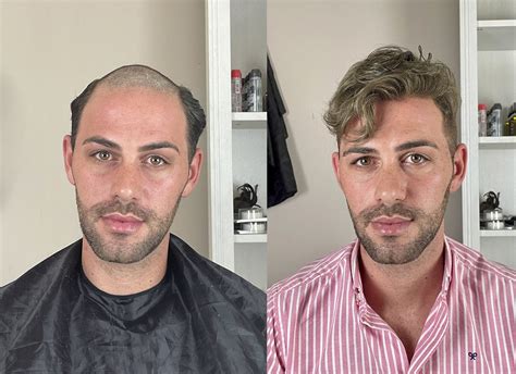 Consulta privada para prótesis capilar masculina