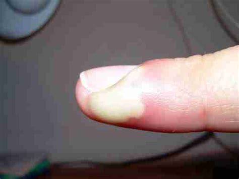 Panadizo gonocócico en dedo pulgar