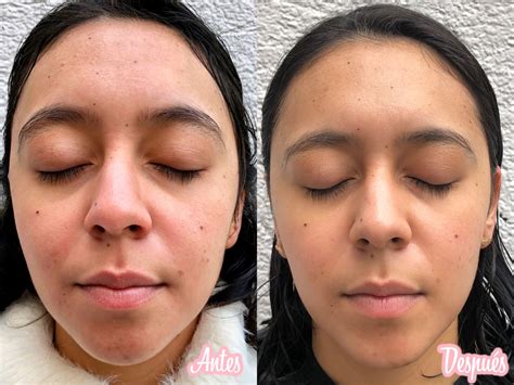 Rostro luminoso antes y después vitamina C