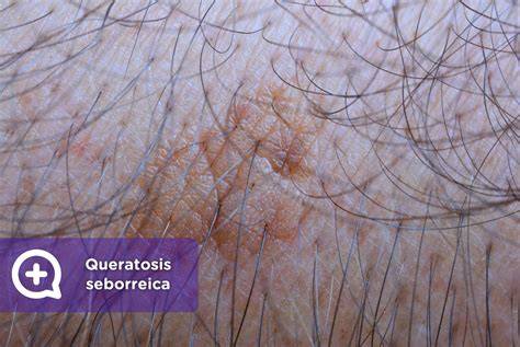 Dermatólogo examinando queratosis seborreica